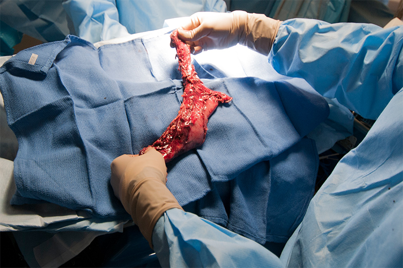 Esophagectomy requires the removal of almost the entire esophagus as well as a portion of the stomach. This operation requires access to both the chest as well as the abdomen. The esophagus and stomach pictured above were removed with a minimally invasive approach using laparoscopy to address the dissection in the stomach and thoracoscopy to perform the dissection in the chest as well as reconstructing the connection, a process known as an anastomosis.