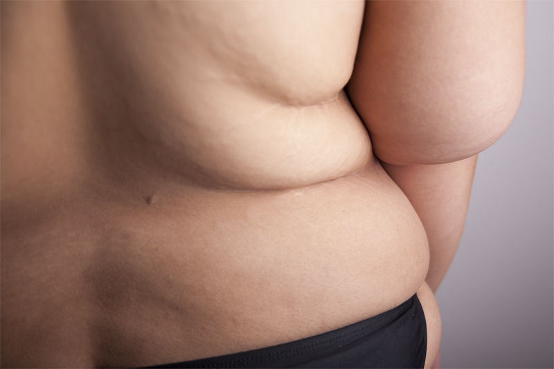 Your body will not magically bounce back to the way it was ten or twenty years ago before you may have started to suffer from morbid obesity. Some amount of excess skin is always expected after surgery-especially if you lose more than one hundred pounds after the operation. Remember, bariatric surgery is meant to alleviate obesity related comorbid conditions and is not cosmetic.