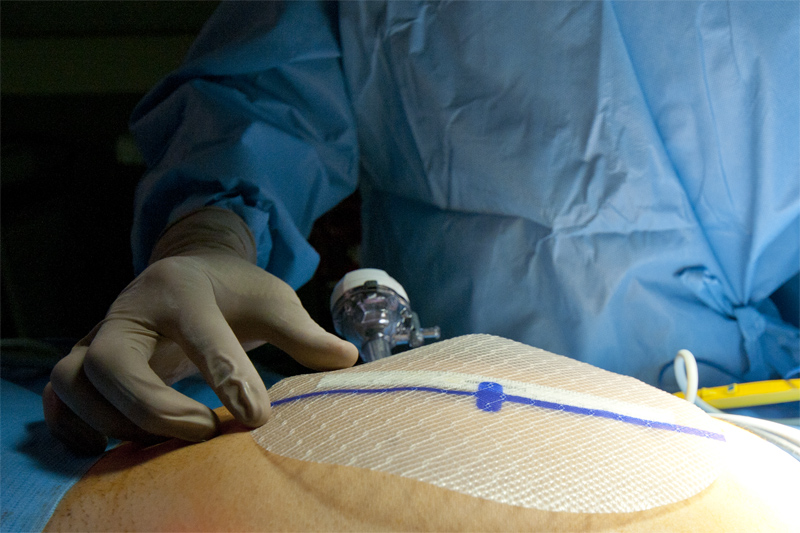 Surgical Mesh Used For Hernia Repair Laparoscopic Md