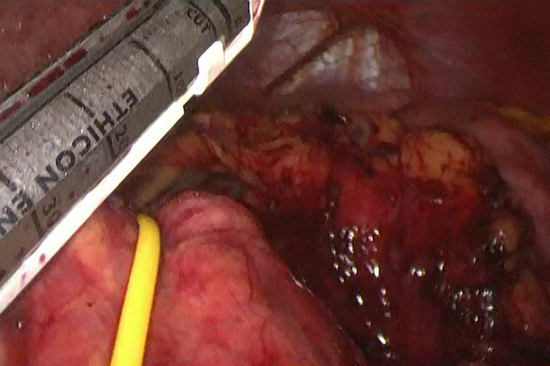 The image above demonstrates a vessel loop that has been placed around the body of the pancreas and is being used for retraction and exposure. At this point the tumor has been confirmed to be located in tail of the pancreas which is located to the right of the stapler. The stapler will be used to cut through and seal that pancreatic tissue in an area with an appropriate distance from the tumor margin. 