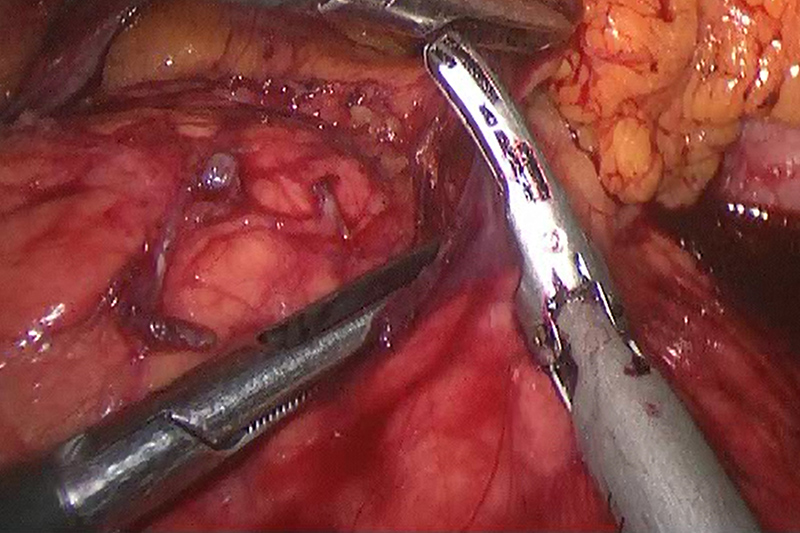 Las técnicas mínimamente invasivas se aplican cada vez más a la resección pancreática por malignidad.Los factores que ayudan a determinar la resecabilidad del tumor incluyen su ubicación en el páncreas, así como su relación con los vasos sanguíneos y órganos circundantes.Esta imagen muestra algo del tejido circundante entre el páncreas y el estómago que se diseca en las primeras etapas de una operación.