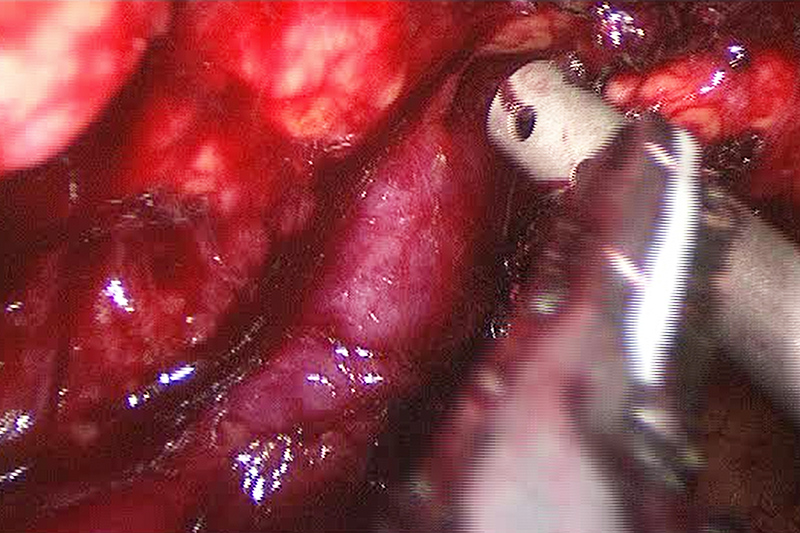 Laparoscopic distal pancreatectomy can be performed from either the body of the pancreas towards the tail or the tail towards moving backwards towards the middle of the pancreas. Usually, the dissection requires a combination of these approaches along with a number of other technical maneuvers. The image above demonstrates the splenic vein that was identified and followed from the body of the pancreas moving outward.