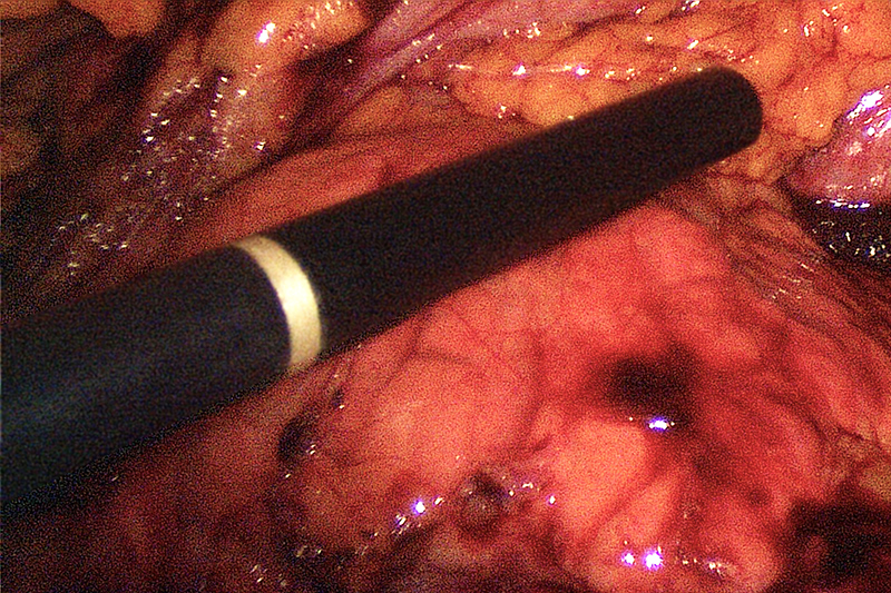 El cuerpo del páncreas se muestra en la imagen de arriba.Se está utilizando una sonda de ultrasonido para deslizarse hacia adelante y hacia atrás a lo largo del páncreas con el fin de visualizar un tumor que se identificó y se siguió preoperatoriamente tanto en tomografías computarizadas como en resonancia magnética. Una pancreatectomía distal laparoscópica puede ser posible para tumores localizados en la unión del cuerpo y la cola del páncreas.