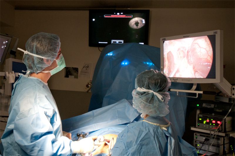 The operation to open up the muscle fibers of the lower esophagus are best served with a combination of a laparoscopic and robotic approach. The stomach needs to be mobilized and the area around the esophagus freed from attaching tissue. The robot can then be used to finely divide the layers of the muscle fibers over the mucosa ensuring that the most complete myotomy possible is performed.