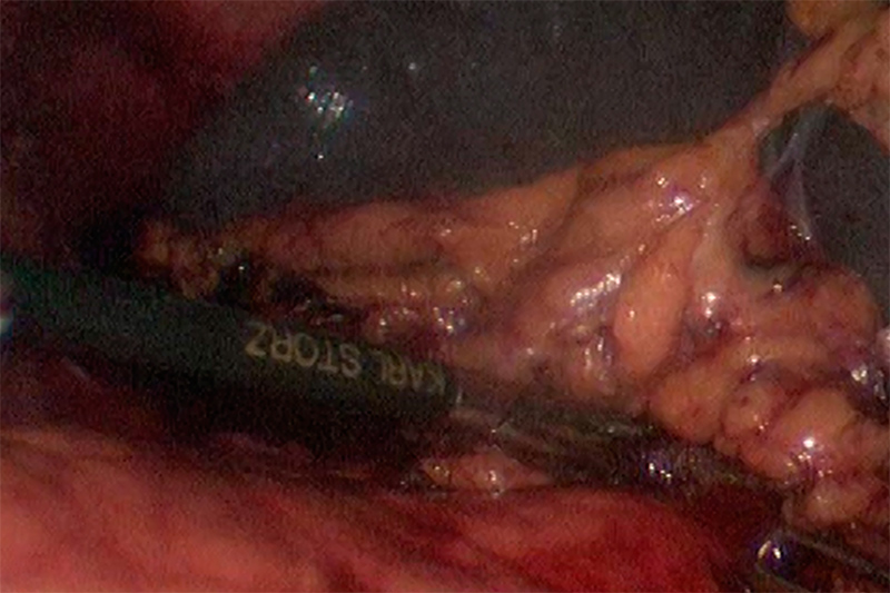 The spleen is carefully tucked away between many sensitive organs that help with digestion and filtering your blood. There are multiple connecting pockets surrounding the spleen that are lined with small blood vessels. Laparoscopic splenectomy requires careful identification and ligation of the various ligaments that surround the spleen.