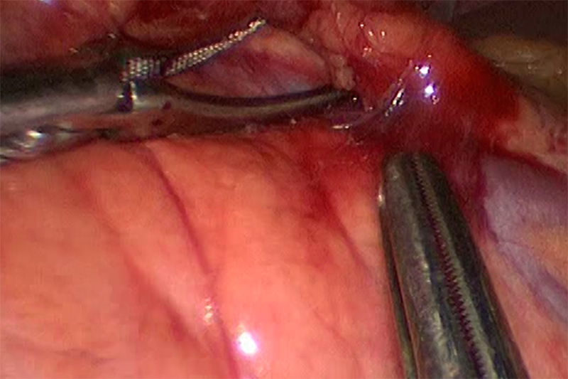 El bazo se encuentra en la parte superior izquierda de su abdomen.Las operaciones en el bazo requieren una disección muy cuidadosa alrededor de una porción del estómago, una porción del páncreas, una porción del colon y el borde de uno de los riñones.Una gran parte de la operación involucra una disección justo arriba del páncreas.Esta imagen demuestra las primeras etapas de identificación de la arteria y la vena al bazo.El vaso azul entre las mandíbulas del disector es la vena esplénica, el tejido amarillo tostado en la parte inferior izquierda de la imagen es el páncreas.