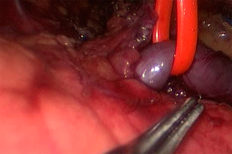 Although the spleen has multiple sources of blood flow, the largest sources is from the splenic artery with its respective drainage from the splenic vein. Depending on the reasons for splenectomy, there may be a possible advantage to ligating (stopping the blood flow) of the artery before the vein. This image demonstrates a vessel loop placed around the large splenic vein to prepare it for stapling. The splenic artery can be seen at the top left of the photo with the staples already across.