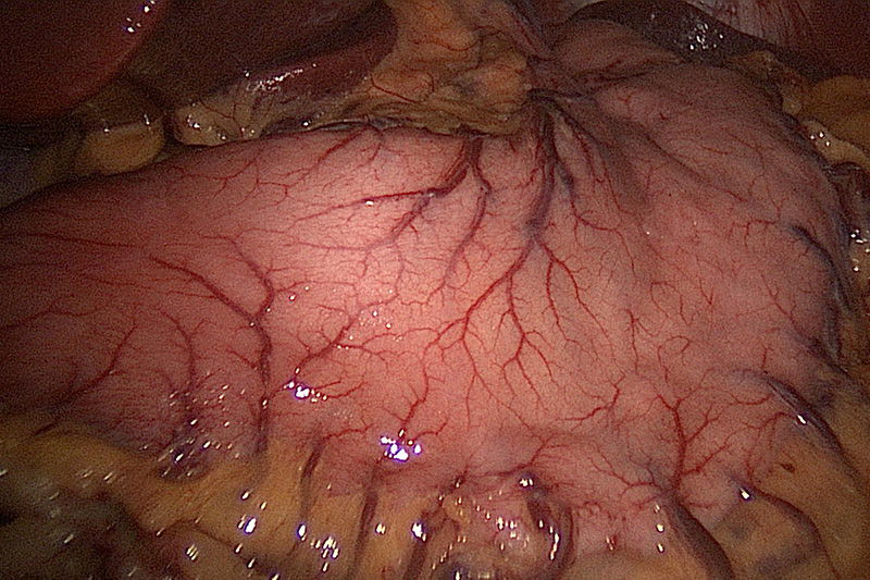 La foto muestra la vista laparoscópica del estómago durante las primeras etapas de una operación de gastrectomía en manga.El estómago es un órgano bastante grande con un suministro redundante de sangre y nervios.Los dos órganos bronceados en la parte superior de la imagen son el hígado a la izquierda y el bazo a la derecha.La imagen muestra la forma J del estómago.Los grandes vasos sanguíneos y el giro abrupto del estómago en el lado izquierdo representan el área conocida como angular incisure o angularis incisura.