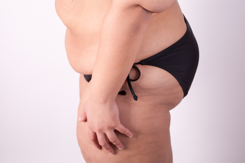 Obesity surgery can sometimes restore regular ovulation Studies have shown that as little as a 10% weight reduction can be effective in restoring regular ovulation and menses. Surgery for morbid obesity is typically very successful in normalizing menses. Please remember that it is dangerous to become pregnant after bariatric surgery for up to two years depending on which operation you have had performed. You need to be extra mindful of using contraception after your operation.