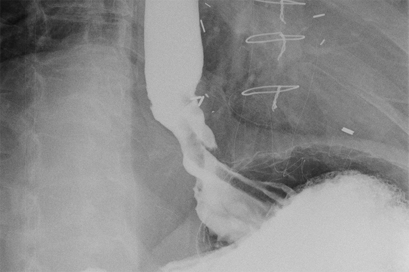 barium swallow of distal esophagus.