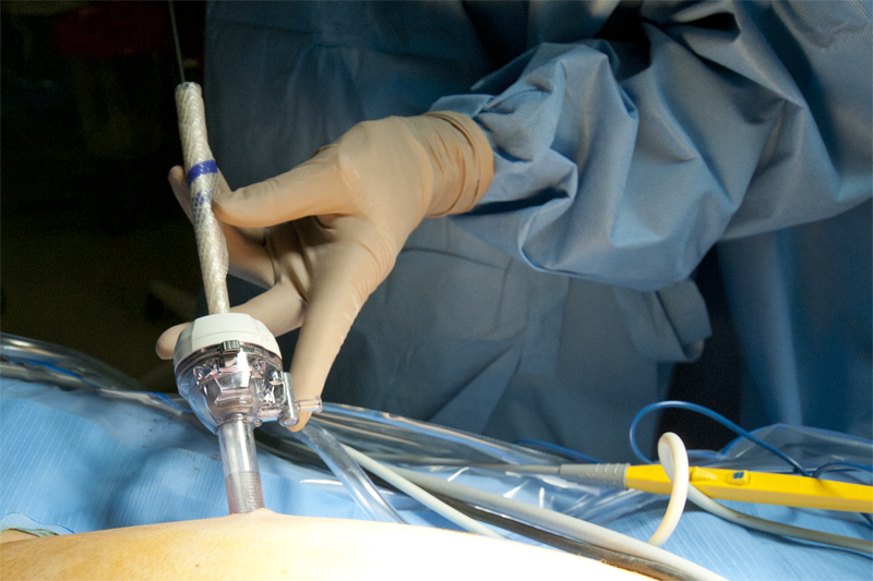 Laparoscopic repair of hernias typically require mesh. A ventral hernia occurs when a hole develops in the muscular layer that surrounds and protects the abdomen. These holes may develop because of previous surgery, childbirth, weight-loss or just simply aging. This photo demonstrates measurements and surgical planning that help ensure optimal intra-abdominal placement of the mesh.