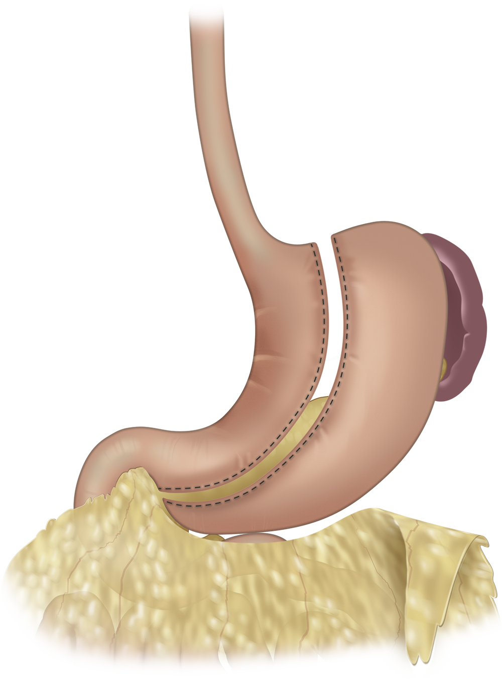 Illustration of Sleeve with omentum removed