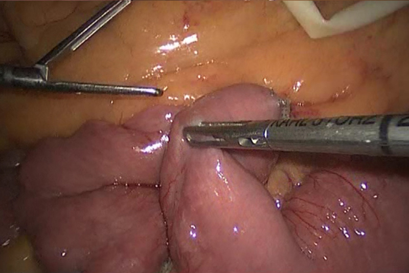 Gastric bypass surgery requires that the intestines are divided and reconnected. The intestines are changed from being a single continuous tube into a Y shape.