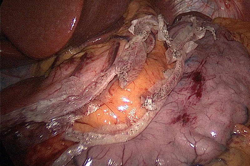 Sleeve Gastrectomy Stomach Division.