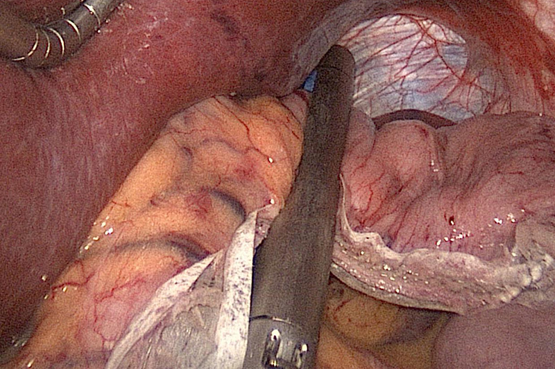Sleeve Liver Dissection