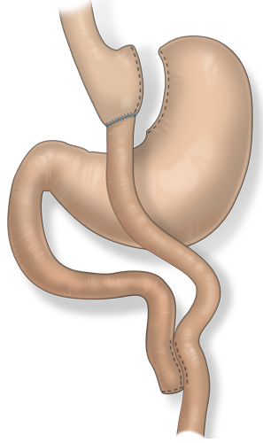 Illustration of the laparoscopic gastric bypass