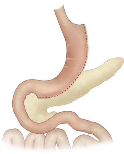 Illustration of the laparoscopic gastric sleeve